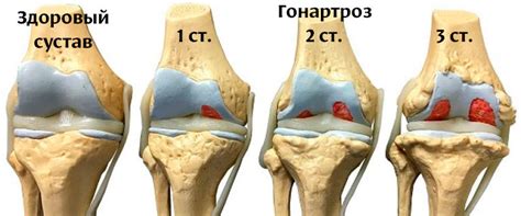 Сильная боль при артрозе коленного сустава - методы лечения